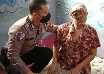 Tumor Ganas Hampir Menutup Semua Wajahnya, Polisi Bantu Carikan Pendonasi 