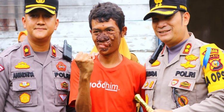 Peduli Warga, Kapolres Bengkalis Bantu Penderita Penyakit Kanker Kulit Berobat ke Rumah Sakit
